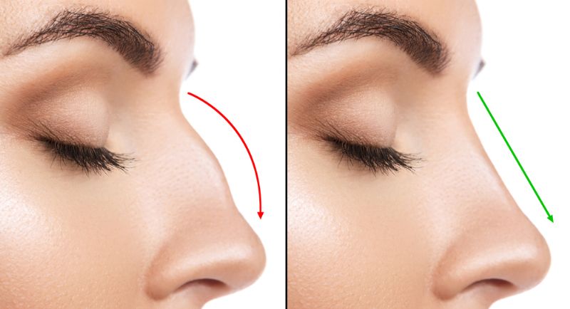 RHINOPLASTY